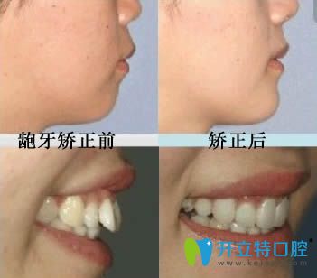 開(kāi)立特口腔網(wǎng)站齙牙矯正前后對(duì)比圖