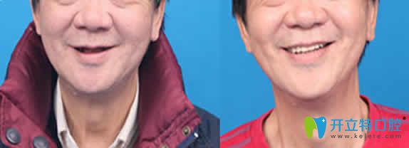牙大夫口腔種植牙前后效果對比圖