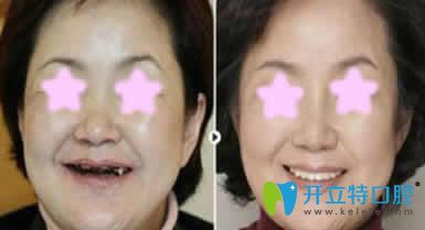 烏魯木齊凱樂口腔蘇爽種植牙案例效果圖