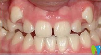 青島維樂口腔隱形矯正牙齒前