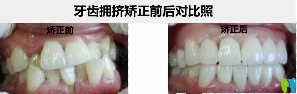 哈爾濱圣琪王曉琳院長牙齒擁擠不拔牙矯正前后對比照 哈爾濱圣琪王曉琳院長牙齒擁擠不拔牙矯正前后對比照