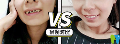 牙博士口腔怎么樣？看牙齒全瓷冠修復案例前后對比圖