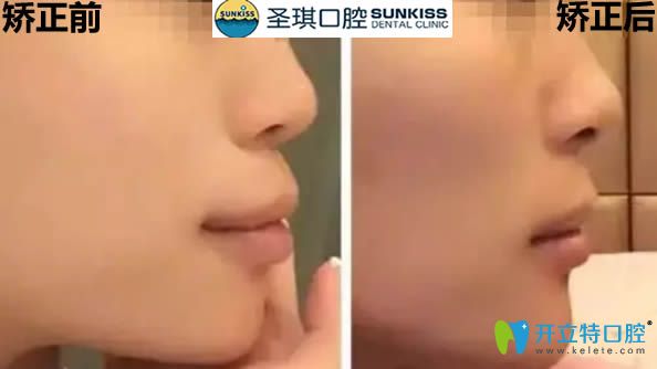 拔四顆牙的臉型變化圖 拔四顆牙的臉型變化圖