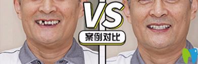 牙博士口腔好嗎？看牙博士種牙案例效果