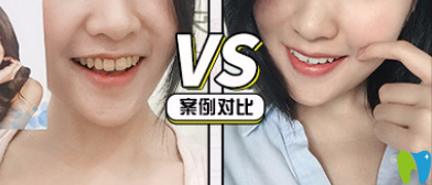 青島牙博士口腔好不好？看牙齒美白真人案例來驗證