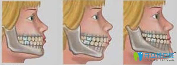 齙牙妹顏值氣質齊飆升奧秘 請看牙齒矯正會后悔一輩子嗎