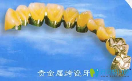 貴金屬烤瓷牙的使用壽命會更久