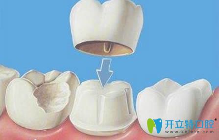 開立特口腔網(wǎng)烤瓷牙套圖片