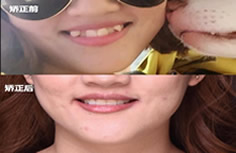 半隱形牙套矯正虎牙畢業(yè)啦 分享我的矯正前后變化圖及感受