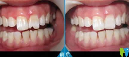 瓜子牙修復(fù)前后效果對比圖