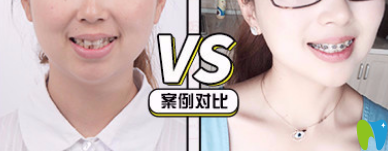 王蕓金屬托槽矯正牙齒案例