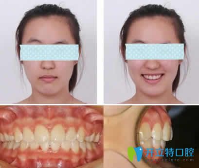 我在無錫通善口腔做隱形齙牙矯正一年后效果 我在無錫通善口腔做隱形齙牙矯正一年后效果