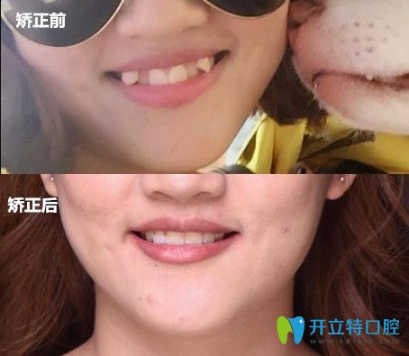 牙博士口腔虎牙矯正前后效果對比圖