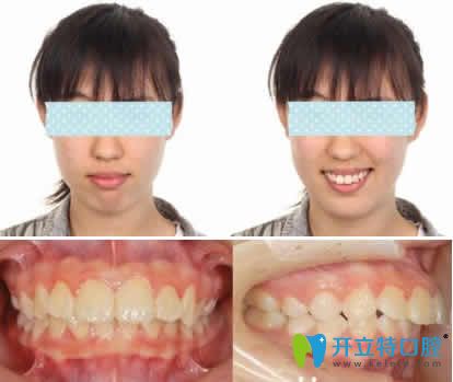 妹子在無錫通善口腔做隱形牙齒矯正價格不貴但齙牙不見了 