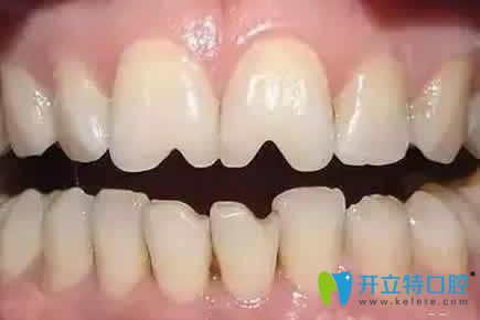 想知道瓜子牙怎么修復(fù)嗎 提供關(guān)于瓜子牙修復(fù)多少錢及方法