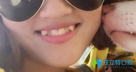 在青島牙博士口腔做虎牙做半隱形矯正前樣子