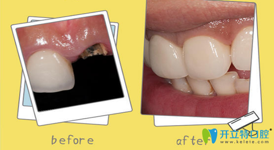 歡樂(lè)仁愛(ài)口腔單顆牙缺失種植案例