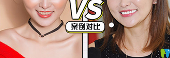 在沈陽(yáng)歡樂(lè)仁愛(ài)口腔做牙齒瓷貼面治療前后對(duì)比案例