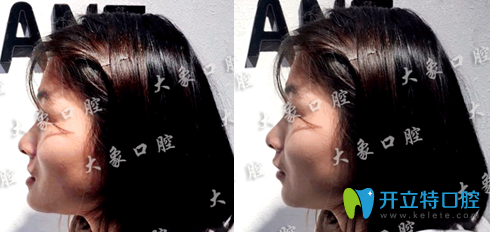 林美岑成人牙齒反頜矯正案例