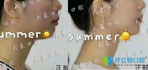 林美岑牙齒深覆頜矯正案例前后對(duì)比圖