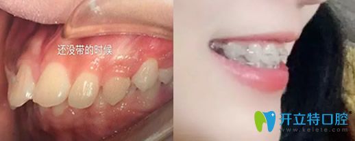 26歲牙齒正畸前后對比圖