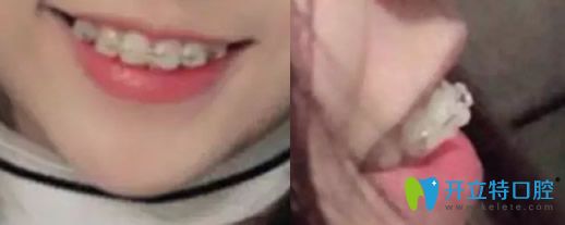沈陽歡樂口腔牙齒正畸剛戴牙套兩個時候的照片