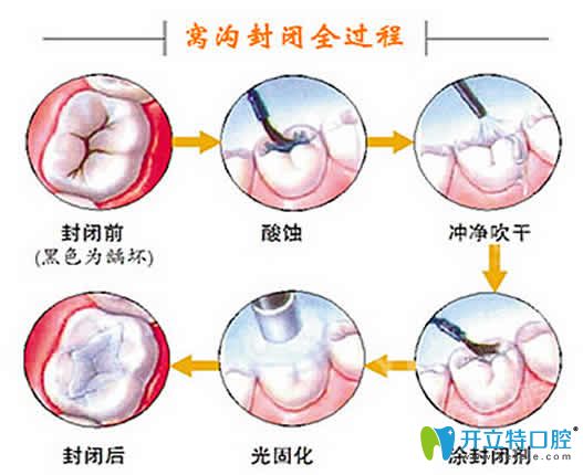 兒童牙齒窩溝封閉多少錢?分享全新的窩溝封閉價(jià)格及利弊