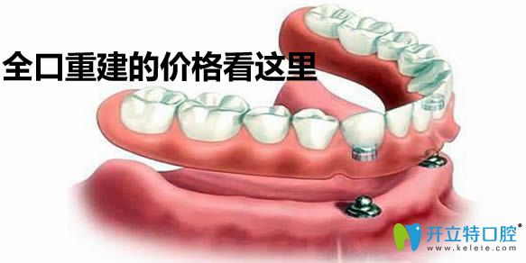 全口重建的價(jià)格在這里