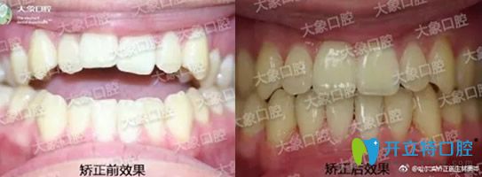 從哈爾濱大象牙科價目表及口碑評價看大象口腔貴不貴