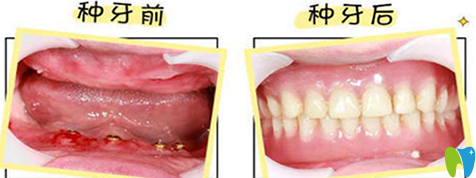 沈陽歡樂口腔全口牙缺失種植案例 沈陽歡樂口腔全口牙缺失種植案例