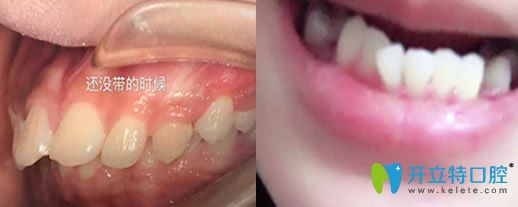 在沈陽歡樂口腔做牙齒正畸前的樣子