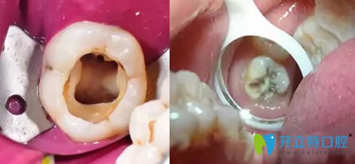 牙壞了一半爛掉圖片