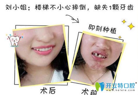 孫延單顆牙齒缺失即刻種植案例 孫延單顆牙齒缺失即刻種植案例