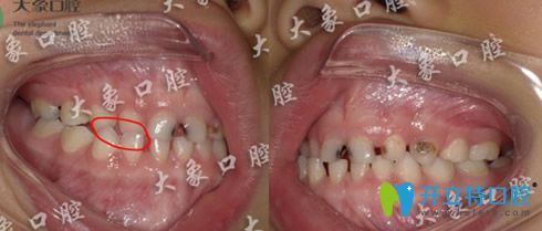 林美岑5歲兒童部分反頜矯正案例對(duì)比照