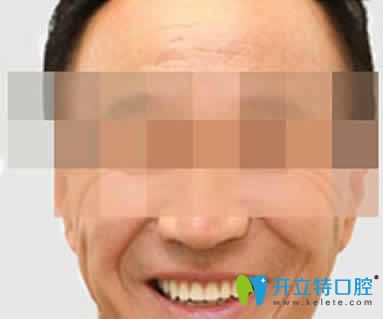 無(wú)錫通善口腔王杏松即刻種植牙案例效果圖