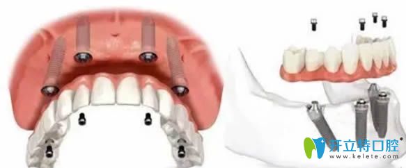 解析全口重建需要多少錢？?jī)r(jià)格和假牙為什么相差這么大
