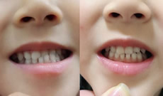 分享3歲女兒在哈爾濱大象口腔做反頜矯正1個月來感受及變化