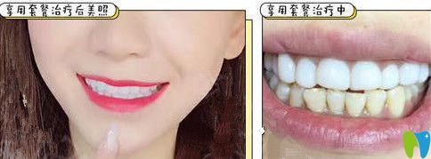 <!--<i data=20240703-sp></i>-->口腔皓齒美白治療前后對比案例