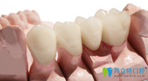 納米烤瓷牙是金屬牙嗎？納米烤瓷牙多少錢？