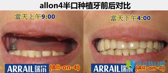 杭州瑞爾口腔allon4種植牙真實案例