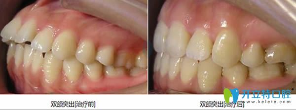 泉州維樂(lè)牙科雙頜前突矯正對(duì)比照