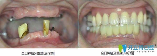 泉州維樂(lè)全口種植牙真實(shí)案例