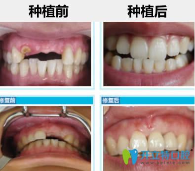 杭州瑞爾齒科<!--<i data=20240703-sp></i>-->鑫醫(yī)生半口種植牙前后對比案例 杭州瑞爾齒科<!--<i data=20240703-sp></i>-->鑫醫(yī)生半口種植牙前后對比案例