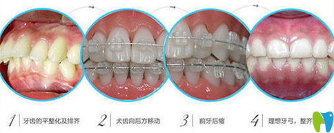 在<!--<i data=20240703-sp></i>-->口腔做半隱形牙齒矯正案例及牙齒變化過程圖