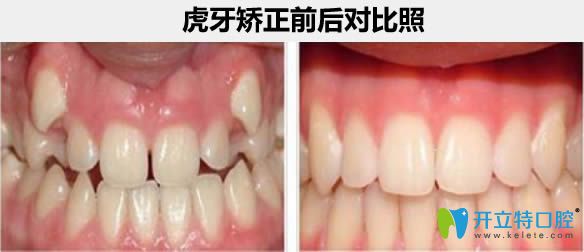 杭州瑞爾齒科成人虎牙矯正案例及前后對比照
