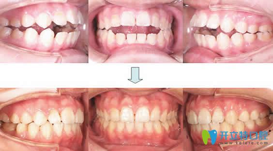 寧波尚善口腔李俏牙齒矯正前后效果對比圖