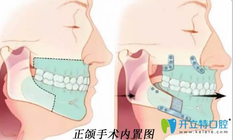 解答正頜手術的費用是多少錢和什么情況需要做口腔正頜
