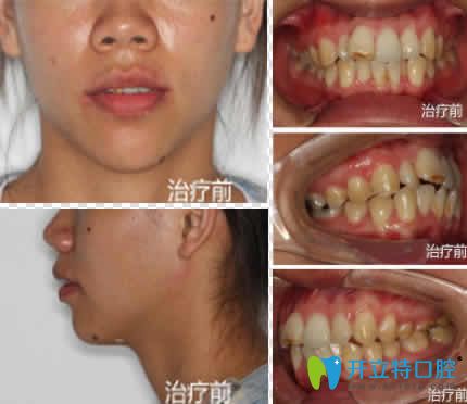 分享我找寧波尚善口腔李俏做隱形牙齒矯正前后對比照片