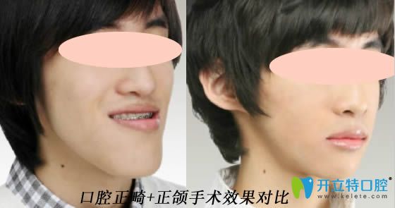 開(kāi)立特口腔正畸和正頜手術(shù)效果對(duì)比圖