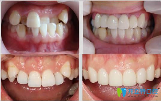 深圳拜博28歲矯正牙齒前后對(duì)比照